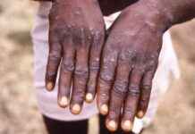 Alles wat je moet weten over het virus MPOX – Informatie en updates news-16082024-145303