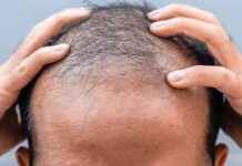 Nieuwe doorbraak in kaalheidsonderzoek biedt hoop voor kaalheidlijders nieuwe-doorbraak-in-kaalheidsonderzoek-biedt-hoop-voor-kaalheidlijders