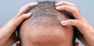 nieuwe-doorbraak-in-kaalheidsonderzoek-biedt-hoop-voor-kaalheidlijders